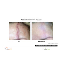 Venus Versa універсальна багатофункціональна платформа для неінвазивних естетичних процедур від Venus Concept